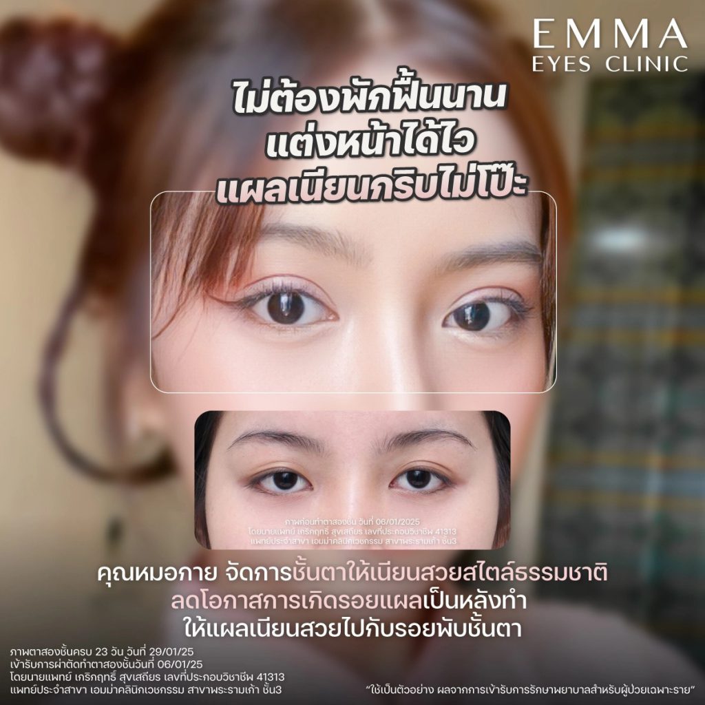 ออกแบบตาสองชั้นให้สวยคม โดยแพทย์เฉพาะทาง Plastic Surgery